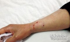 被狗咬傷后的簡單急救